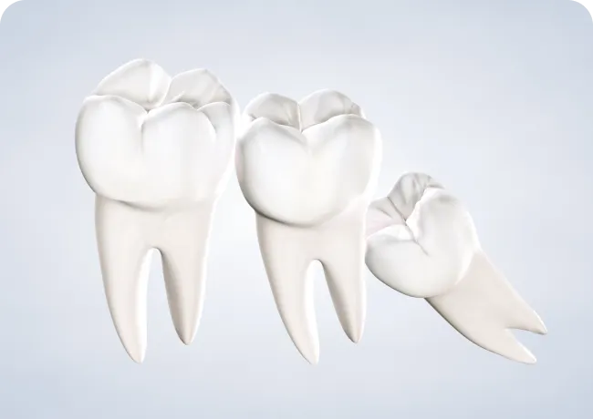 Home Wisdom Teeth Removal