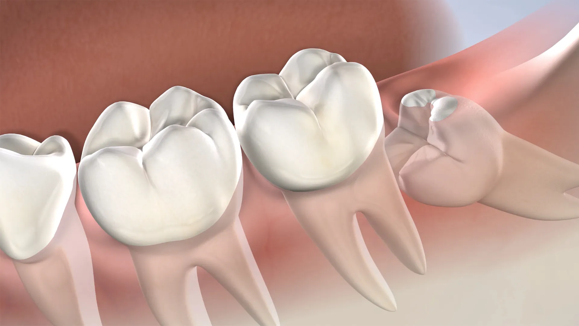 Instruction  wisdom teeth