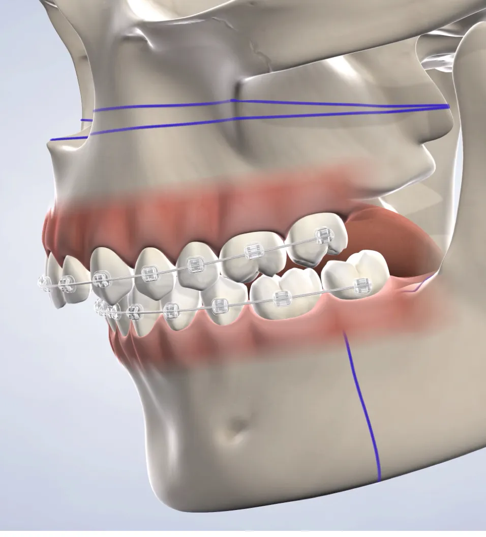Query  jaw surgery