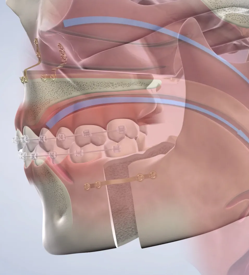 Query  sleep apnea