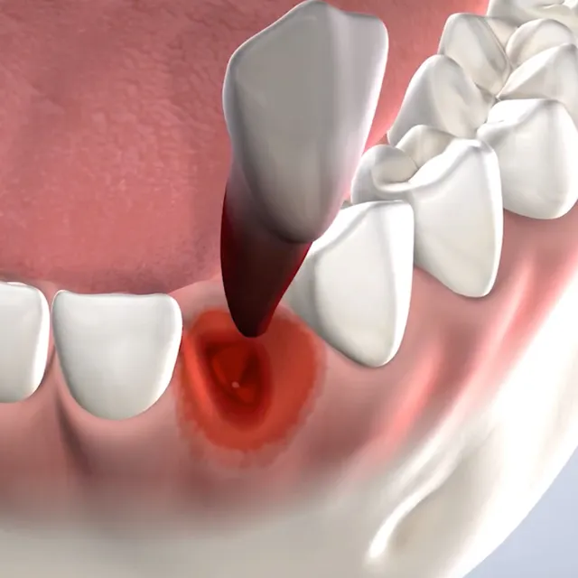 Query  tooth extraction