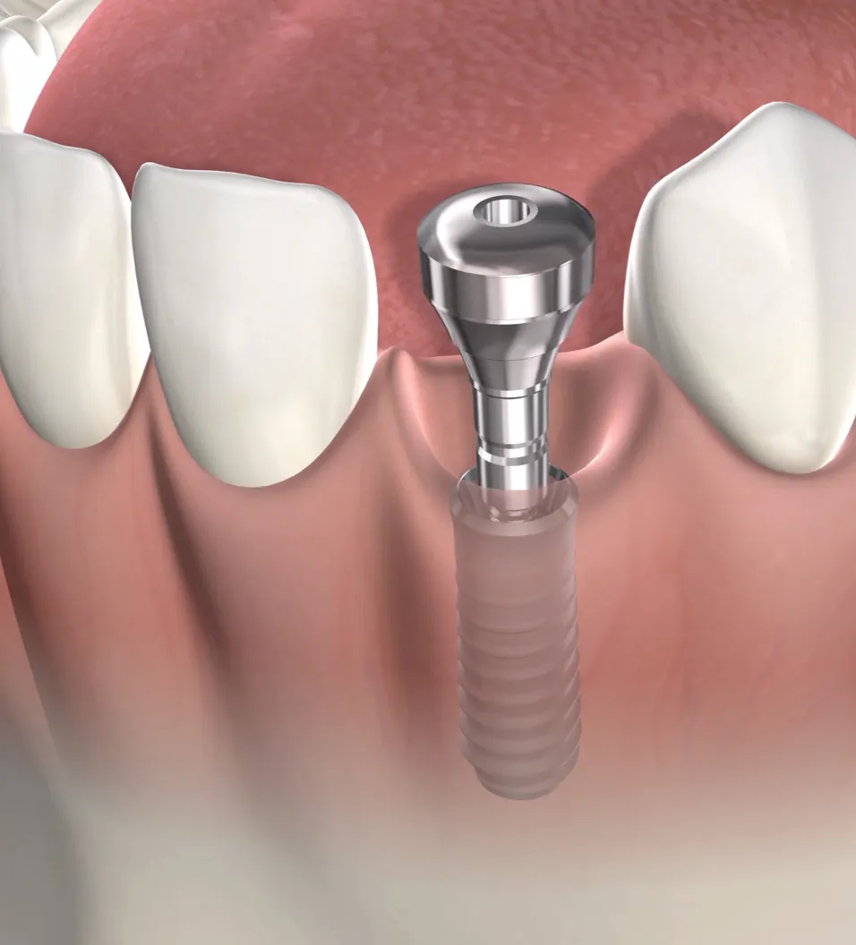 Query  tooth replacement options
