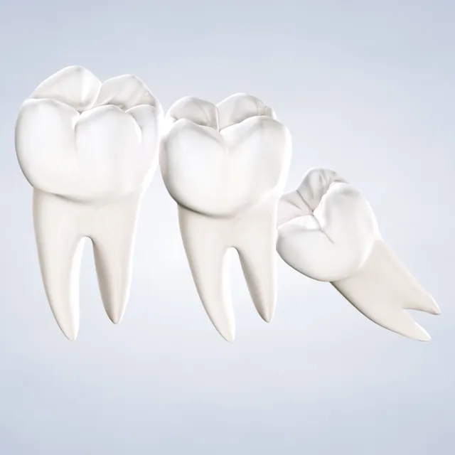 Query  wisdom teeth removal